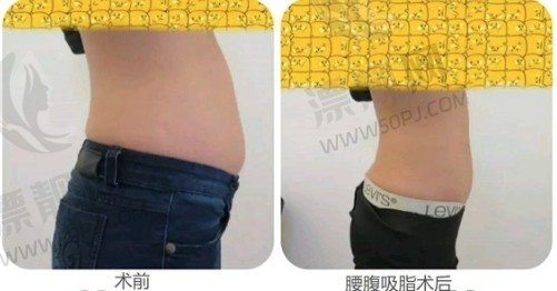 成都恒博天姿整形医院怎么样?吸脂价格:腰腹吸脂9k起/全身吸脂2w起