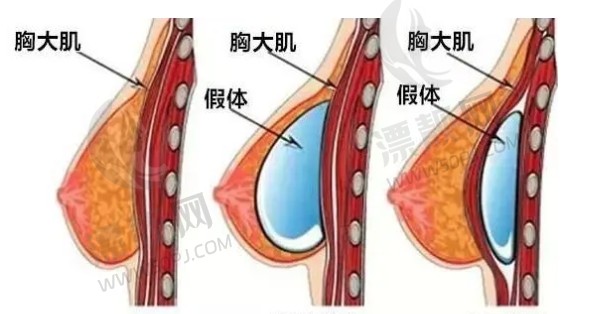 假体隆胸