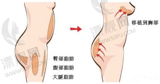 自体脂肪隆胸