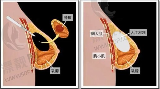 巨乳缩小失败修复