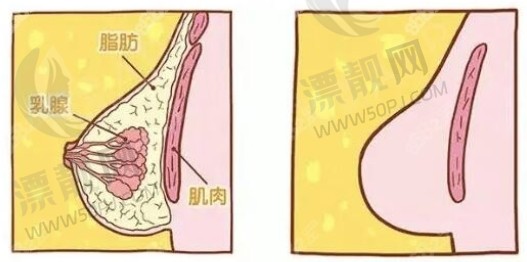 抽脂缩小巨乳