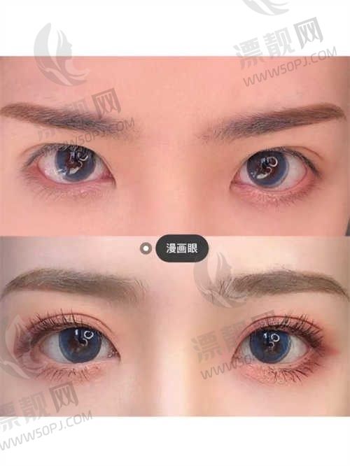 成都致心医疗美容医院埋线双眼皮7100元起，精细化定制方案