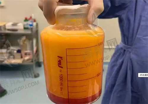 陈万芳吸脂怎么样