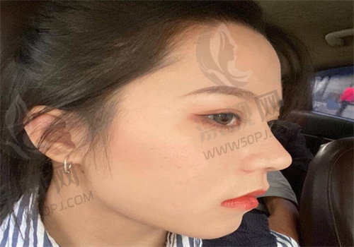 上海假体隆鼻医生排名前十