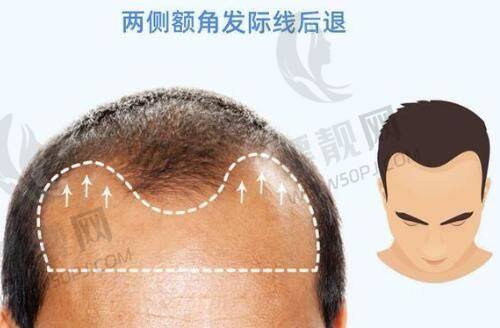 激光祛斑与点痣成效揭秘