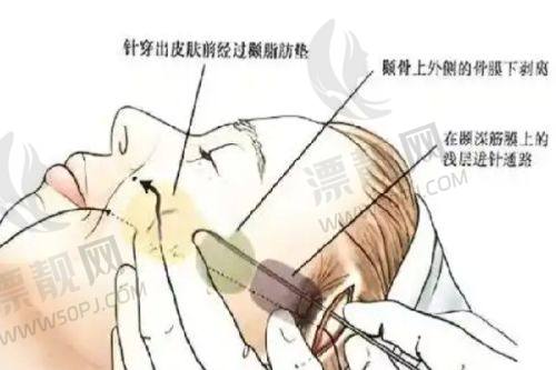 如何选择适合自己的祛斑点痣方案