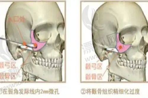 眼部整形:专精优势尽显