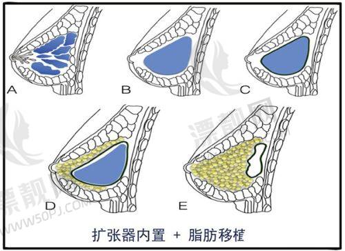 为什么选择杨丽医生做眼袋修复?
