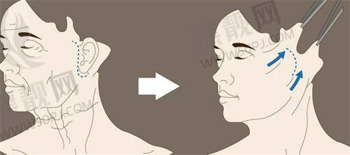 三、抗衰紧肤项目性价比分析