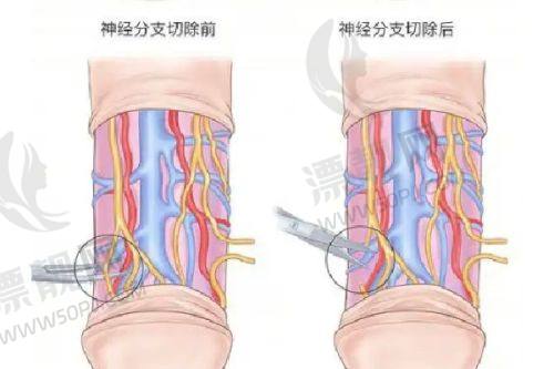术后护理注意事项