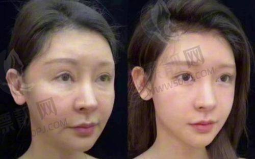如何选择适合自己的填充方式