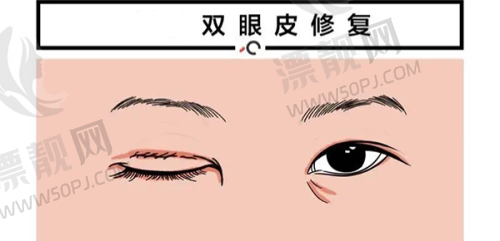 术后注意事项