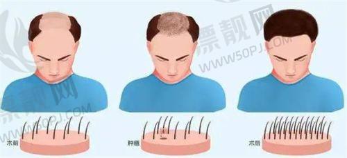 4. 新生植发（术后终身植护管理的先行者）