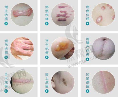 黄金微针的其他功效