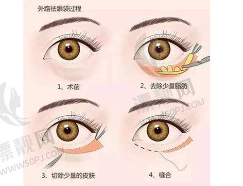 三、打紧缩针的注意事项不能忘
