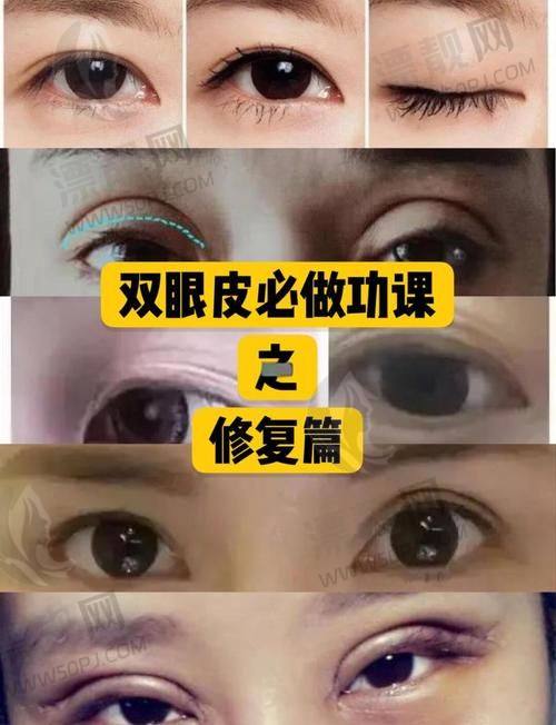 8. 赵悦悦｜南京艾诺美整形｜下垂改良术受欢迎