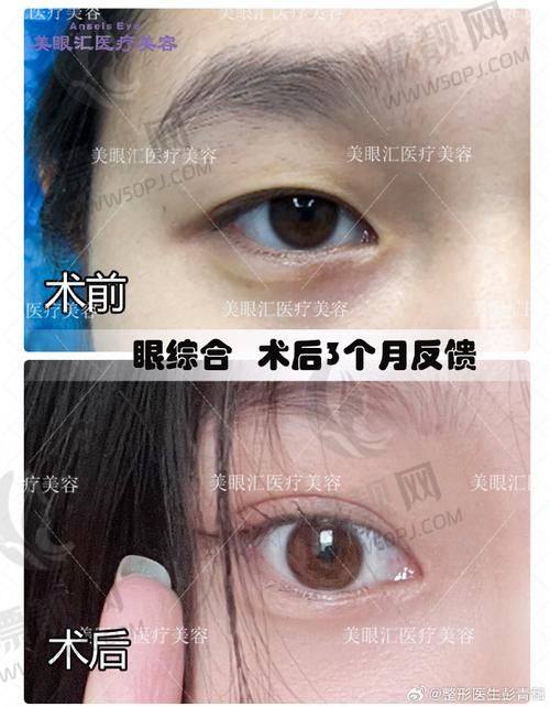 4. 孙玉清｜南京维多利亚医疗美容医院｜宽改窄/内双改善王牌
