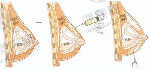 五、避坑提醒与建议