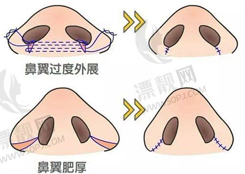 轻薄针是不是就是溶脂针？深度剖析二者成分、原理、部位及效果差异！