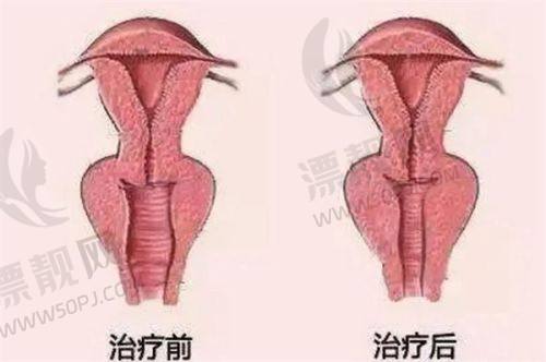 重要提示:选择轻薄针和溶脂针要谨慎!