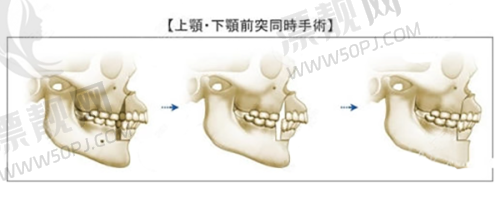 修复手术的