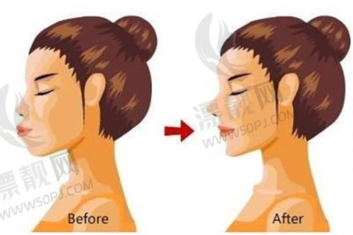 南宁华美整形美容医院拉皮手术术前注意事项