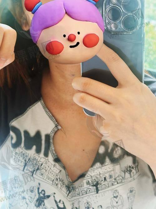 4. 聂婕 - 上海美莱医疗美容