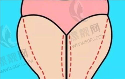 湖南奥美定取出医生排名