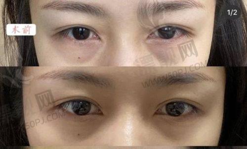 冯啸医生打玻尿酸真的好吗？揭秘骨相还原提升注射的3大优势