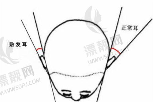 北京润美玉之光医疗美容张红芳水动力吸脂塑形13800元起——创伤小恢复快