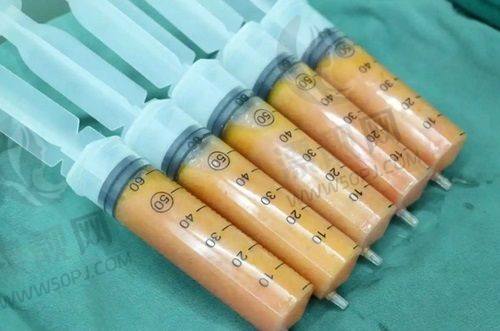 傲诺拉四个系列怎么选？参考各系列价格、特点及适用人群，助你精准挑假体