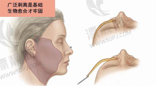 北京京城皮肤医院于莉明医生眼部整形3800元起——自然灵动之美