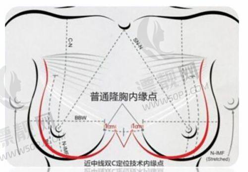 西安艺星窦玺医生隆胸技术优势揭秘