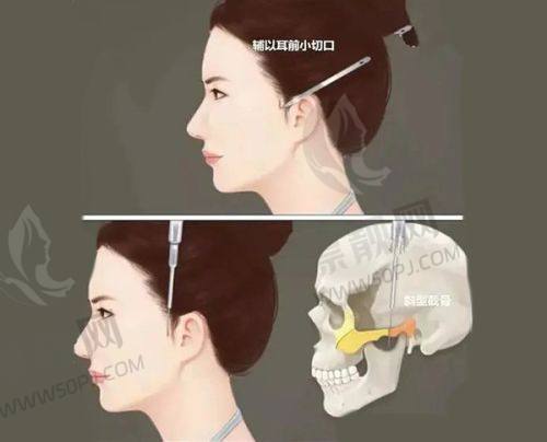 【价格指南】不同疤痕的修复方案预算