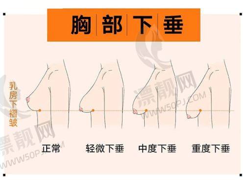 胸部整形手术