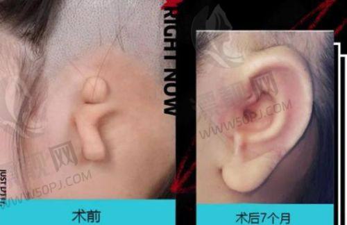 植发前后的注意事项