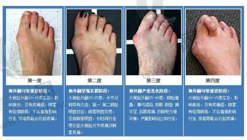 鼻部整形手术