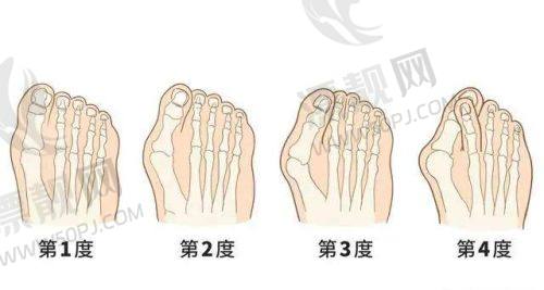 温州艺启美鼻部整形项目价目及优势