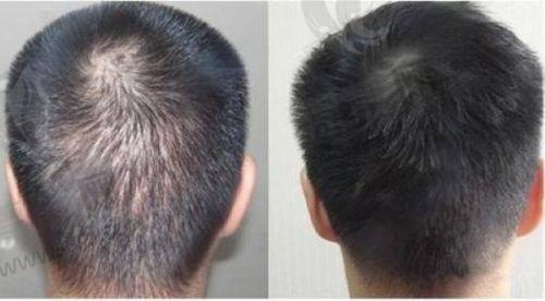 到底选不选南京新生医院植发?脑瓜子轻松想通!