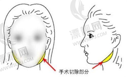 温馨提示:面诊确定方案,提前预约更便捷