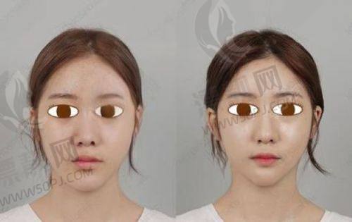 北京八大处吸脂的安心性和成效保护