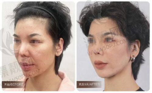 南京华美曹海峰做鼻子多少钱？鼻修复案例对比蒋晟，价格与技术解析
