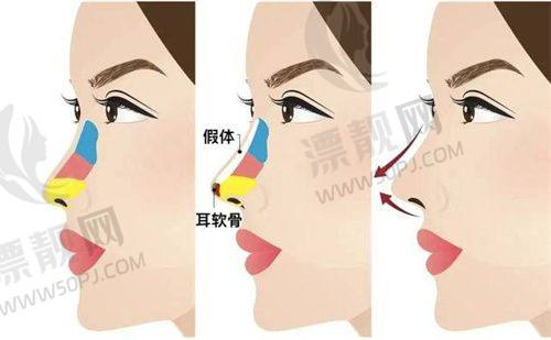 眼部整形项目