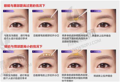 深圳割双眼皮口碑好的医院有哪些？深圳市人民医院、北大深圳医院、深圳二医院排名靠前！