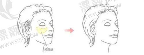 沈阳名流整形医院口碑究竟如何？其祛眼袋手术效果揭秘大曝光！