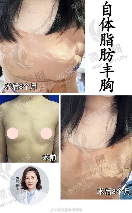 北京禾美嘉吸脂咋样啊？院内有实力医生亲诊而且吸脂的价格也不贵性价比高