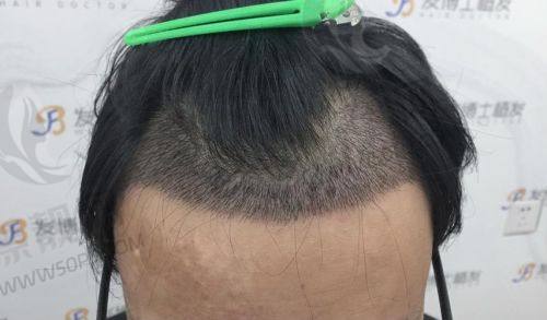 南京新生医院植发怎么样？医院正规挺有实力植发没得说 附植发价格表