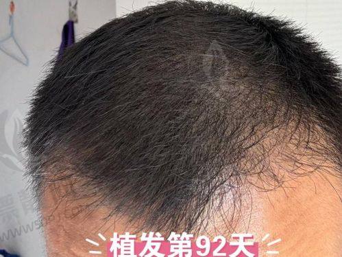 价格透明!南京新生医院植发多少钱?