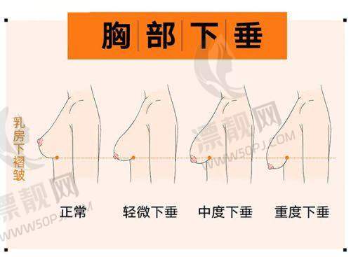 五、成都出彩医美丰胸的修复过程和注意事项