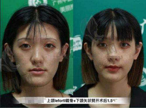 为什么90%的回头客选择筋膜提升?